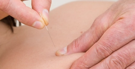 fisioterapia y la relación con la acupuntura